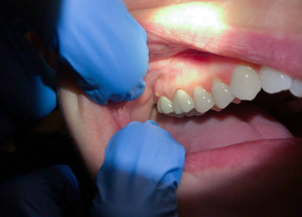 Best Emergency Root Canal Treatment in Marion, VA